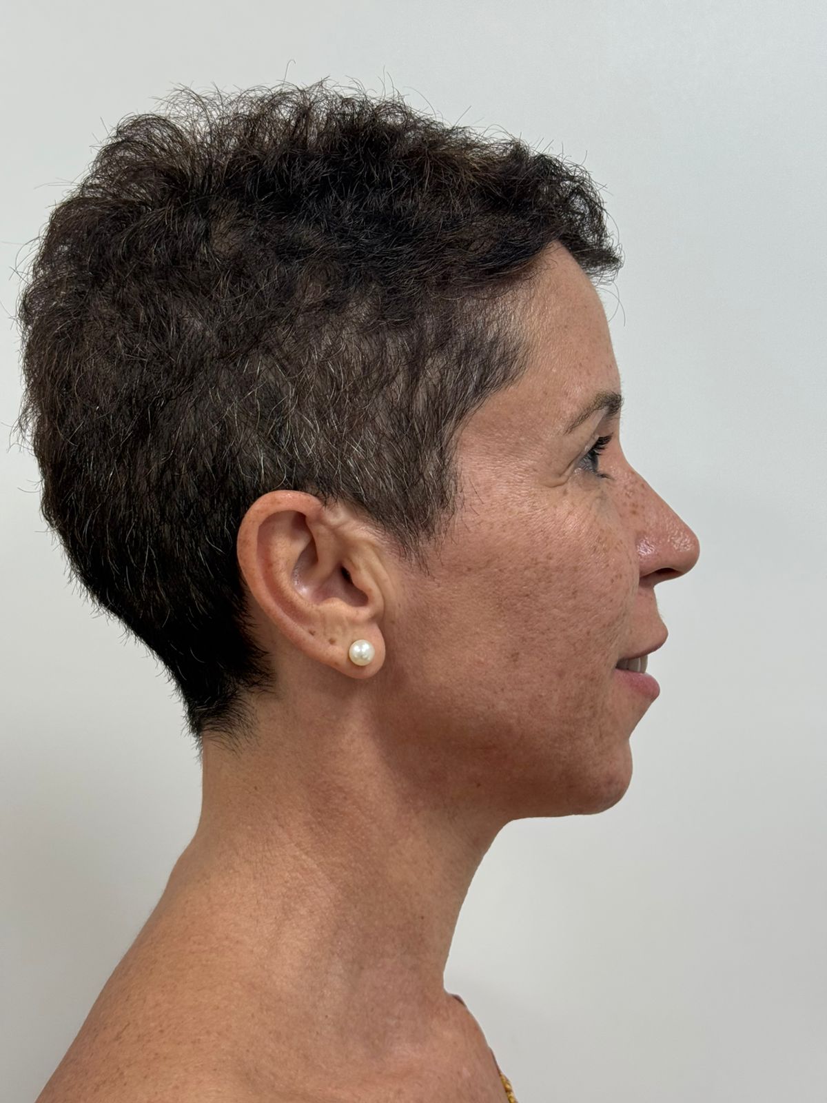 Antes — Harmonização & Toxina