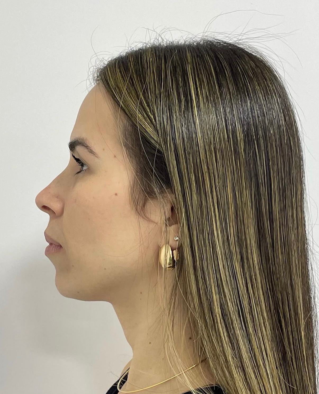 Antes — Harmonização & Toxina