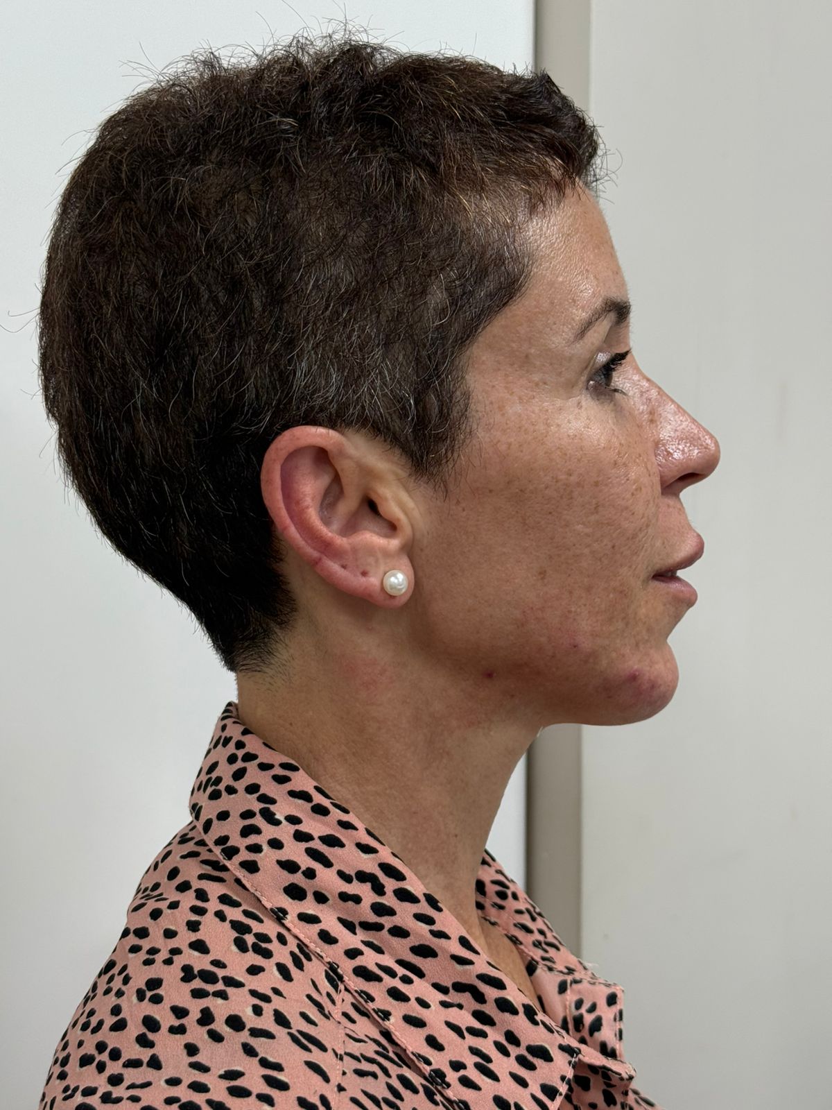 Depois — Harmonização & Toxina