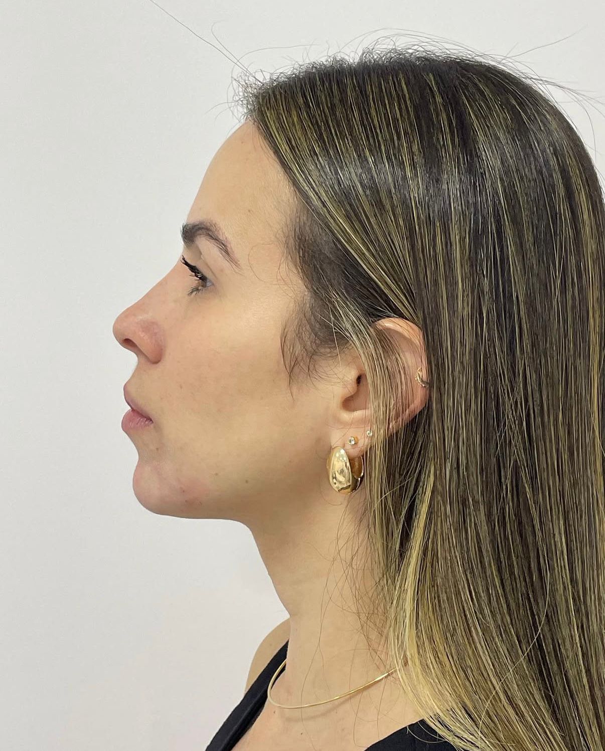 Depois — Harmonização & Toxina