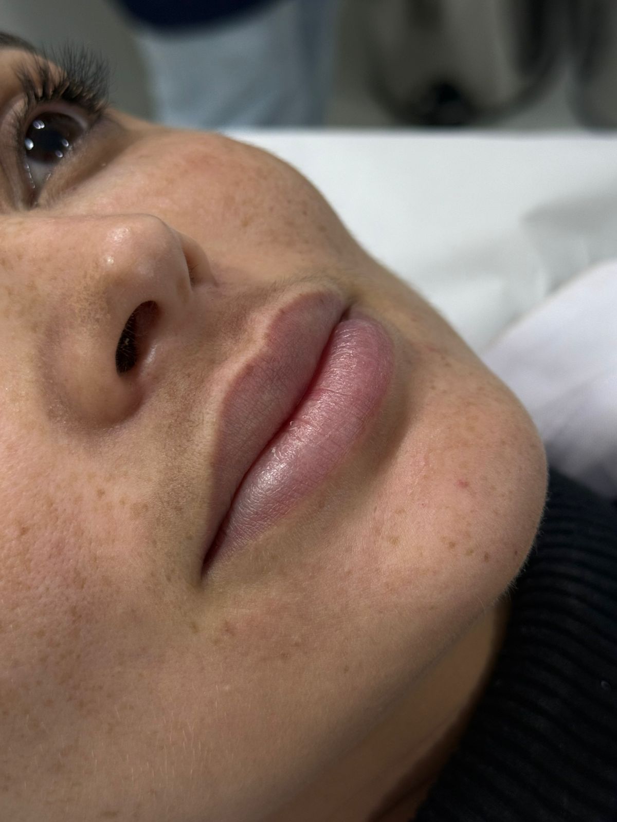 Antes — Preenchimento labial