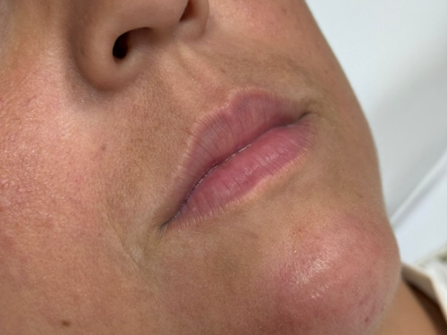 Antes — Preenchimento labial