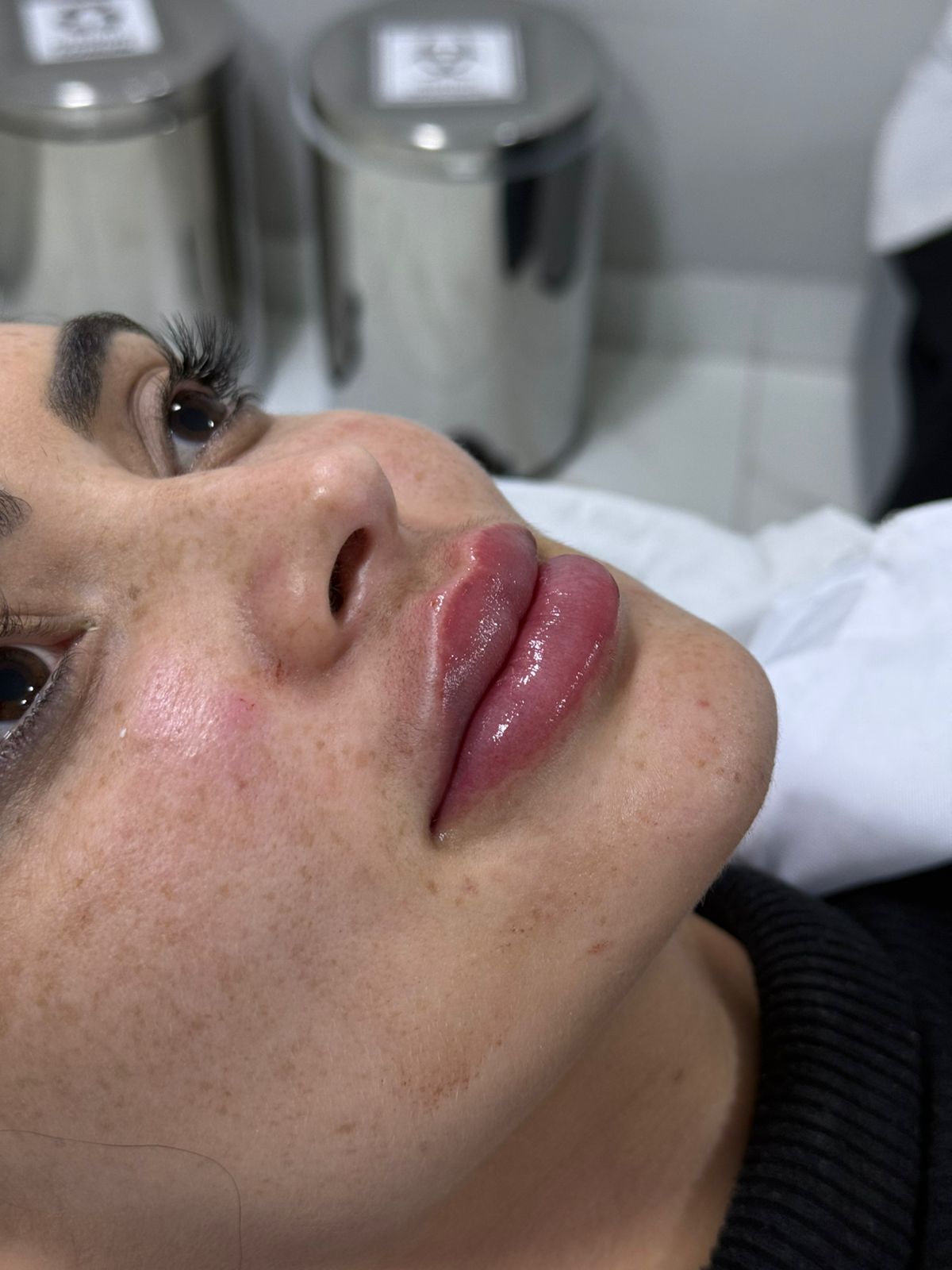 Depois — Preenchimento labial