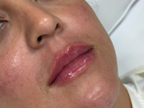 Depois — Preenchimento labial