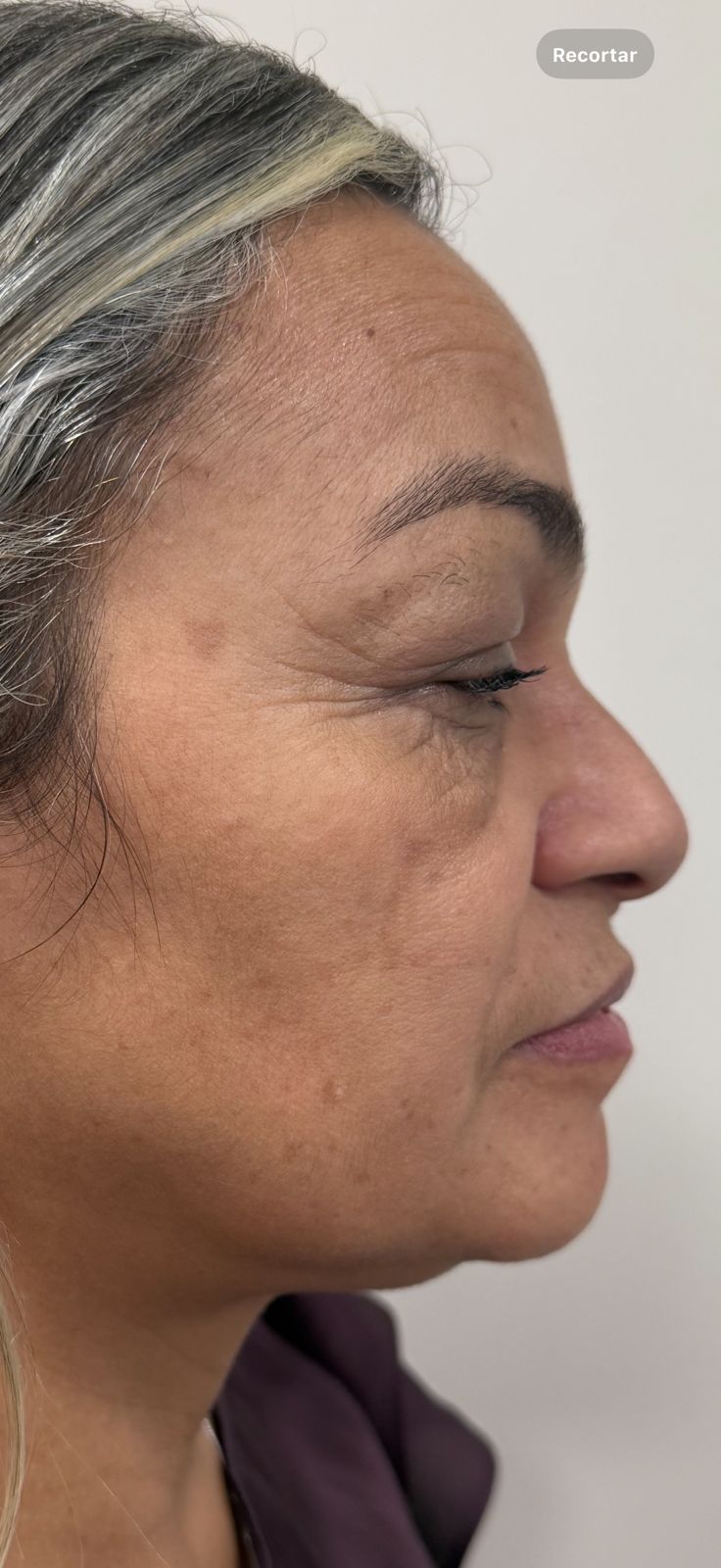 Antes — Skinbooster