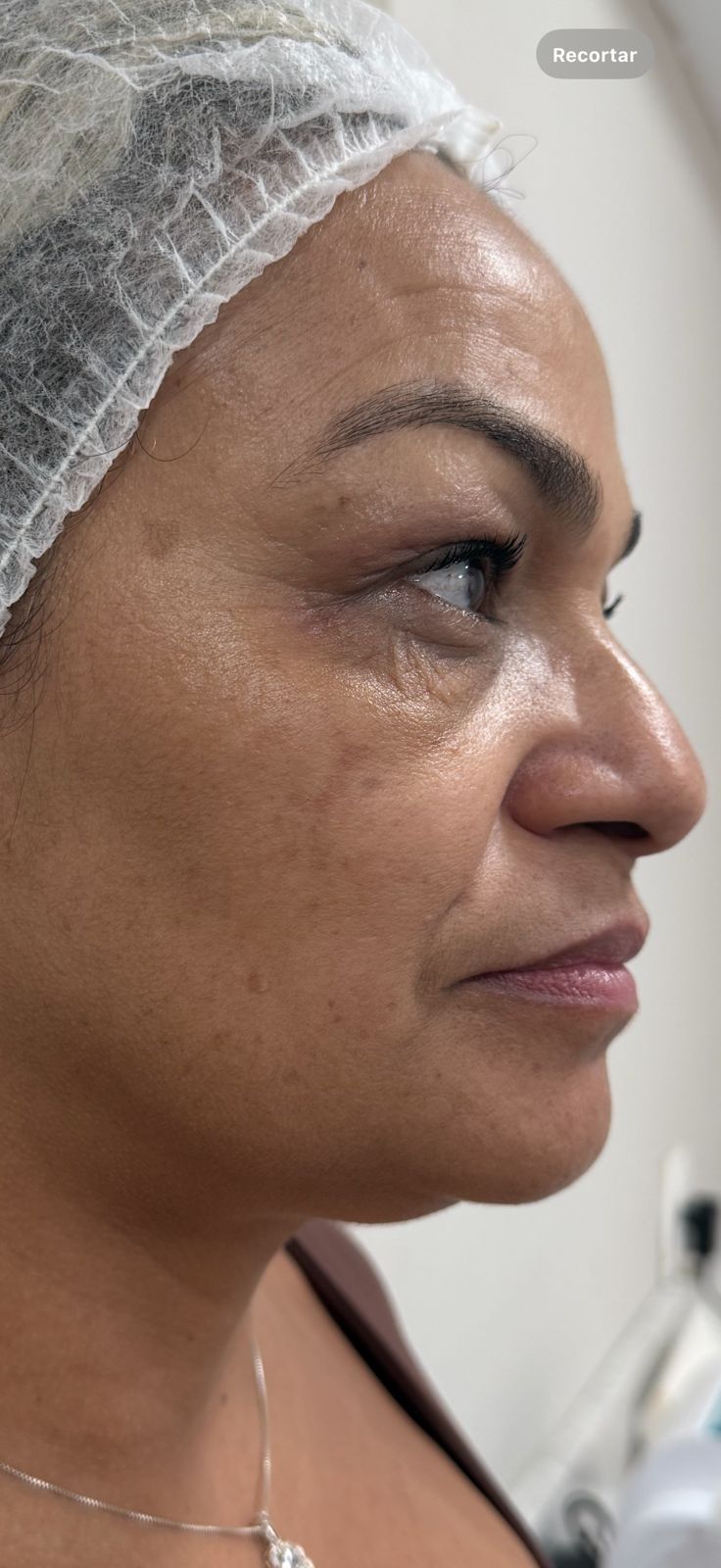 Depois — Skinbooster